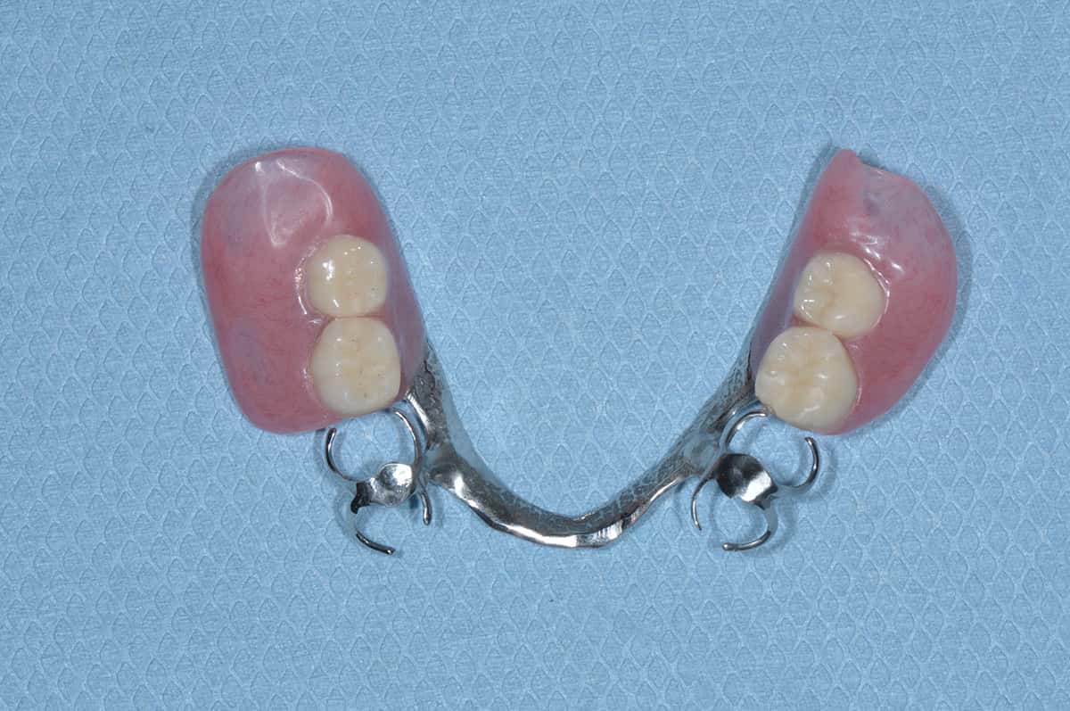 奥歯 2 入れ歯 本 部分 部分入れ歯 奥歯2本を失った場合の治療方法〜インプラントか入れ歯か〜
